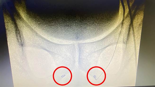 李姓男子内阴动脉出血，院方以心导管栓塞术放入止血线圈栓塞（图中打红点处）堵住出血点。（院方提供／孙英哲彰化传真）