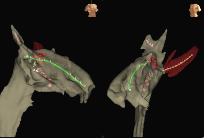 3D定位将搜集到的电生理讯号重建成立体3D图像，图片可以看到在右心房的及右心室的影像，以及导管在心臟的相对位置，粉红色点为烧灼的位置。（恩主公医院提供）