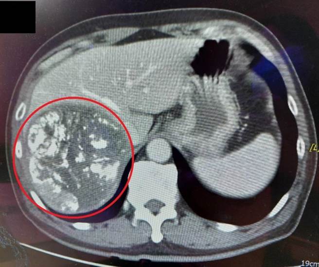 经以动脉肝肿瘤栓塞治疗后，吴先生的肿瘤已缩小(红圈处)，且压迫的血管也已畅通。（大千医院提供／谢明俊苗栗传真）