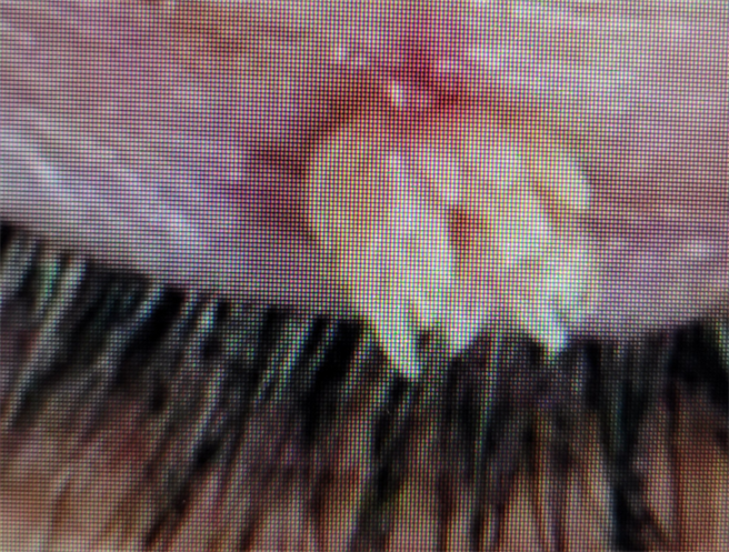 高雄一名27岁陈姓男子平常喜欢去三温暖，却因此感染菜花。（达特杨眼科联盟提供／杨舒婷高雄传真）