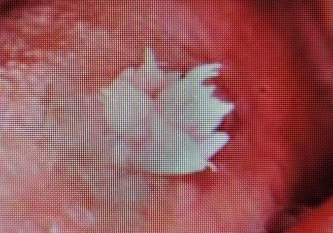 陈姓男子除了眼睛长出菜花外，口腔男、右部手脚也长出菜花。（达特杨眼科联盟提供／杨舒婷高雄传真）