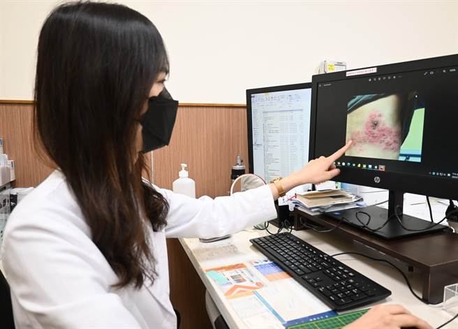 陈郁蓁医师说明45岁男性患者皮蛇分布情况。（台南市立安南医院提供／程炳璋台南传真）