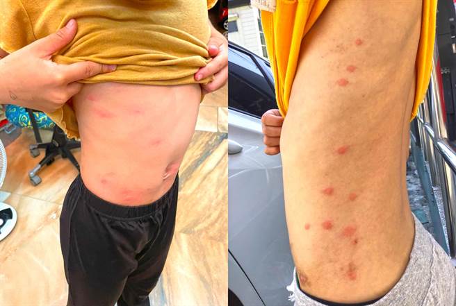 寿山国小每逢入夏就要经歷跳蚤之灾，学童只要一到操场玩，或到后山上户外课就会被咬到满身都是包，家长看了更心疼。（读者提供／袁庭尧高雄传真）