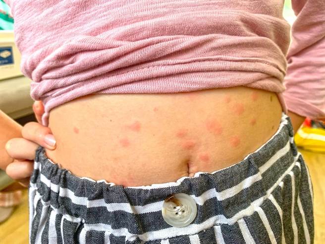 寿山国小每逢入夏就要经歷跳蚤之灾，一个孩子身上竟有50多个咬痕。（读者提供／袁庭尧高雄传真）