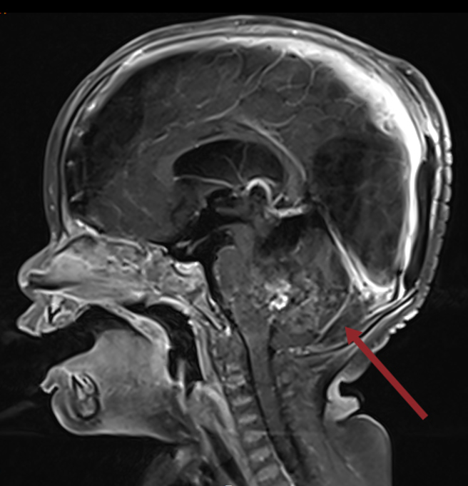北医利用质子治疗，成功救治一名仅10月大的婴儿。（北医大提供）