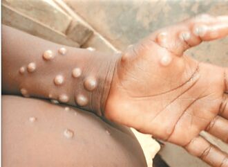 國內首例兒童猴痘 4歲童家戶感染