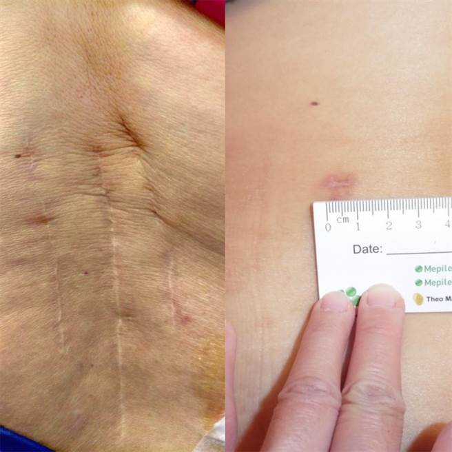 恩主公医院指出，脊椎微创内视镜手术的伤口（图右）只有1~1.5公分，相较传统手术（图左），不仅术后恢復快，更可以早日回归正常生活。（恩主公医院提供）