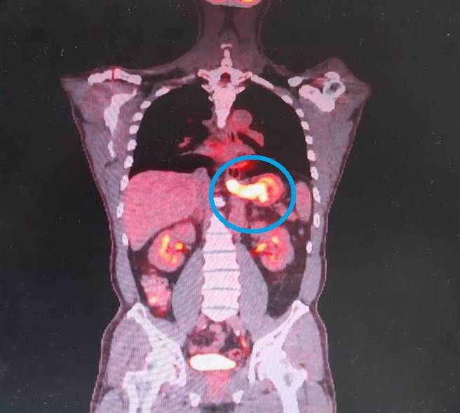 陈先生经正子扫描检查证实为食道癌及胃癌(蓝圈处)。（大千医院提供／李京升苗栗传真）