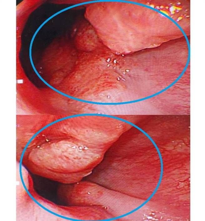 胃镜检查发现陈先生在食道和胃部有肿瘤(蓝圈处)。（大千医院提供／李京升苗栗传真）