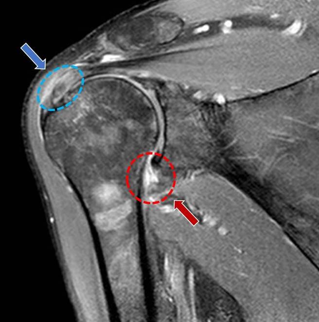 肩膀关节磁振造影检查：上、下箭头所指分别为旋转肌腱发炎处、肩关节囊发炎处。（部苗医院提供／李京升苗栗传真）