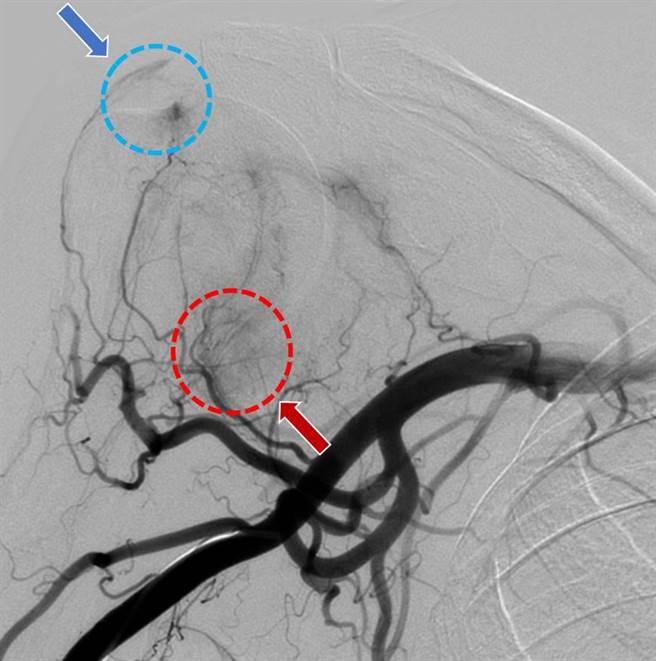 肩膀关节血管摄影检查：圆圈内显示发炎处毛毛样血管增生，异常血管增生处也对应到疼痛位置。（部苗医院提供／李京升苗栗传真）