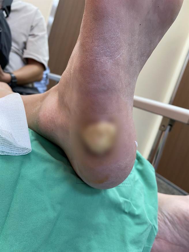 陈姓警员脚底被病毒疣困扰逾两年，最后以上皮电烧手术治癒。（院方提供／孙英哲彰化传真）