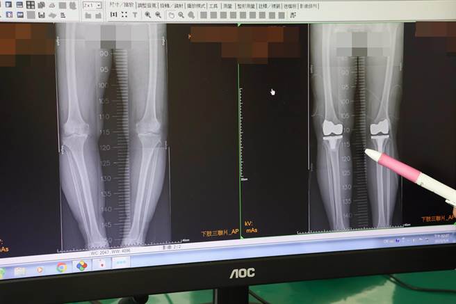 患者術前(左)膝蓋嚴重變形無法走路，術後(右)已恢復正常。（大甲李綜合醫院提供）