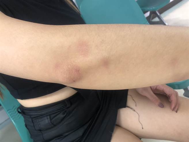 27岁余姓女友手、脚和腰部多处瘀青外伤。(民眾提供／萧嘉蕙台东传真）