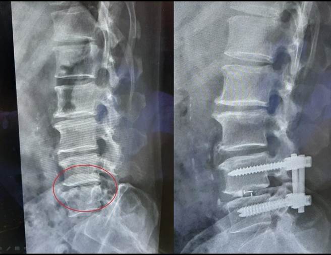 陈先生腰椎疼痛再次復发(左图红圈处)，经骨融合手术后(右图)顺利恢復。（大千医院提供／李京升苗栗传真）