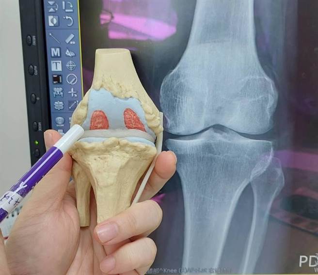 陈先生的膝关节磨损相当严重，导致双脚歪斜又疼痛。（大千医院提供／李京升苗栗传真）