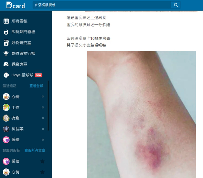 一名女網友慘遭醫師男友性侵，全身上下有10多處瘀青。（圖／翻攝自Dcard）