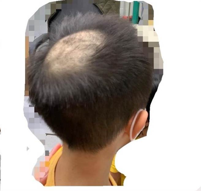 有家長在臉書貼上幼童被採剪毛髮後，頭頂頭髮被剃掉一大圈成「河童」的模樣，心疼表示：「勇敢的孩子！」。（摘自板橋區餵毒幼兒園－受害者聯盟臉書）