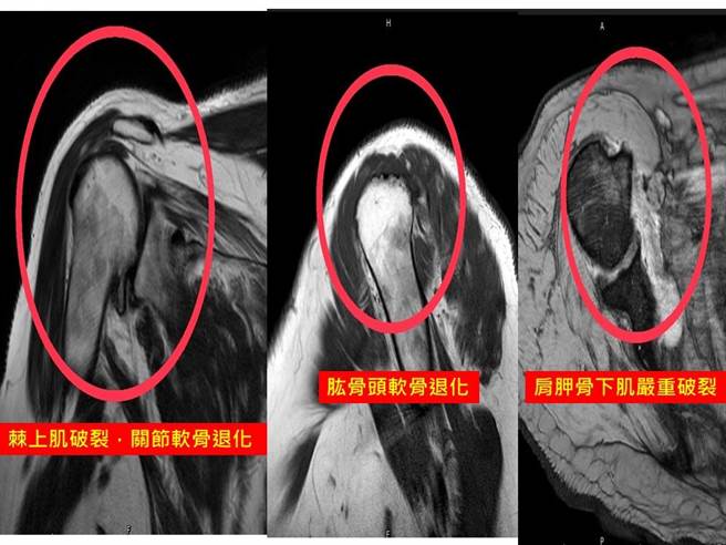 86岁江先生右肩旋转肌近年退化破裂，不仅手臂无法举高且「一动就痛」，连睡觉也时常痛醒，多年来严重影响生活品质。（大里仁爱医院提供／潘虹恩台中传真）