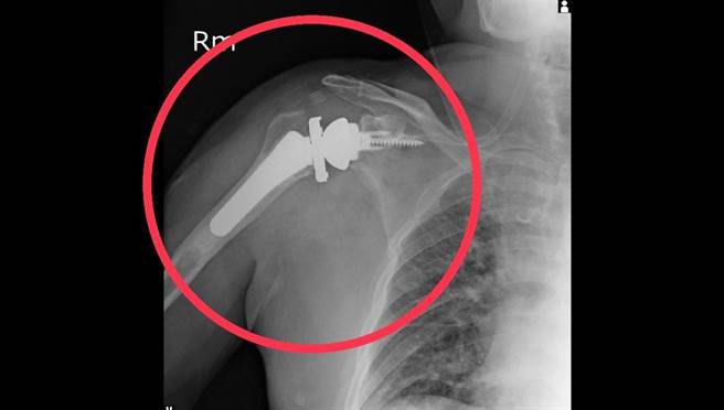 林口长庚运动医学骨科医师邱致皓说明，新一代的反转式全人工肩关节置换设计利用三角肌取代旋转肌，得到更好的效果。（大里仁爱医院提供／潘虹恩台中传真）