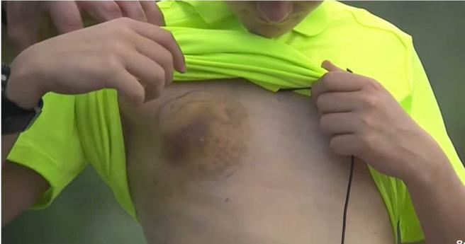 11岁男童伊森掀起上衣，右胸口处仍清晰可见被蛇咬伤的伤口。