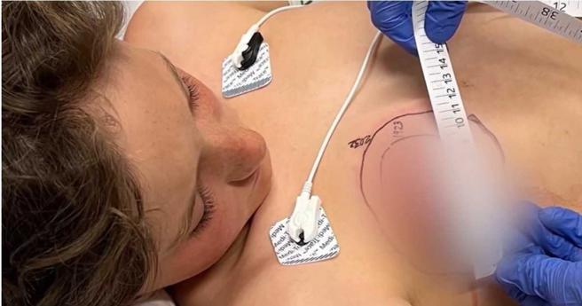 伊森接受长达36小时的治疗与注射16瓶抗蛇毒血清后总算恢復健康