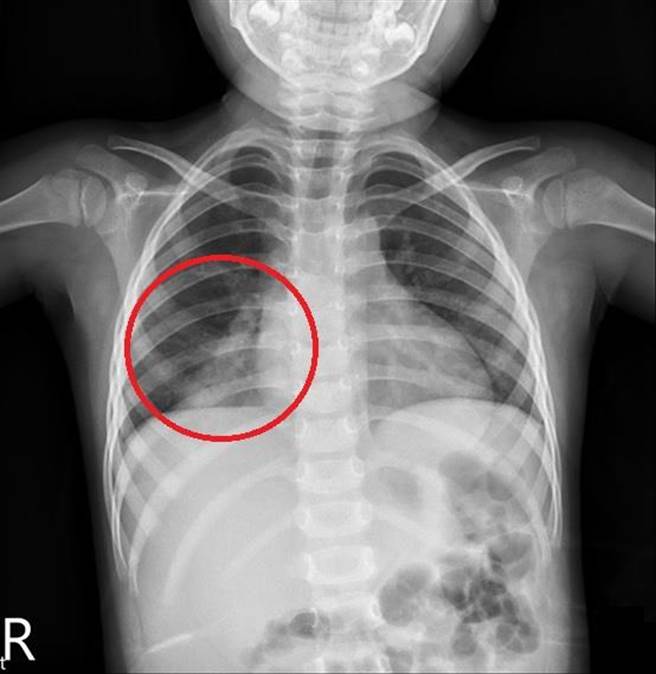 台中3岁女童连续5天高烧40度不退，医师排除新冠病毒、A型流感、霉浆菌及肠病毒等常见疾病后，检查发现为肺炎链球菌，幸给予抗生素治疗后顺利退烧、大幅好转。（亚大附医提供／潘虹恩台中传真）