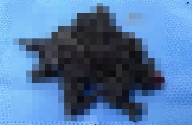 高雄一名50歲許姓女子近3隔月連續脹氣、腹痛，多次服用胃藥都不見好轉，原來是膽結石作祟。（高雄醫學大學附設岡山醫院提供／楊舒婷高雄傳真）