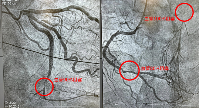 检查发现男子三条心血管有80%、90%、100%阻塞现象。（陈冠任医师授权提供）