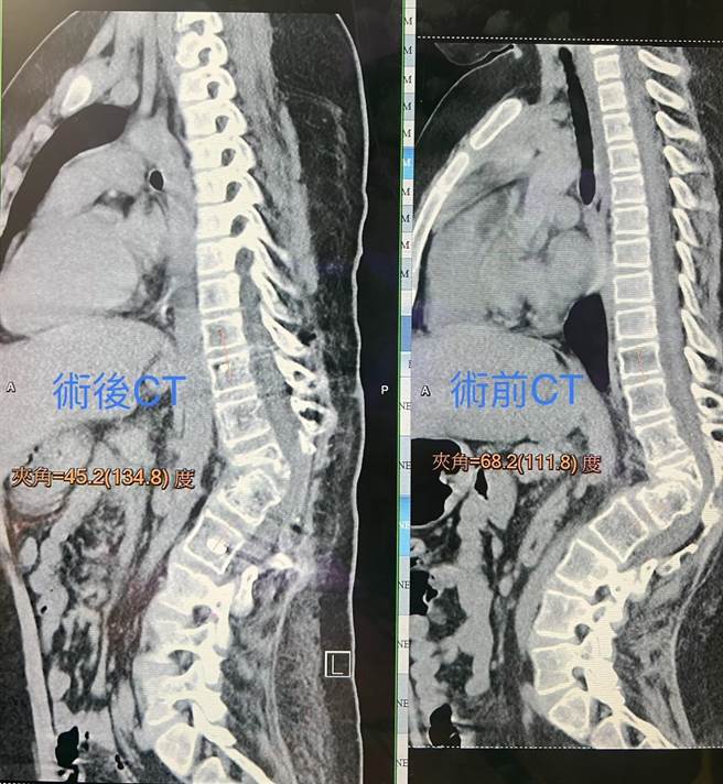 陈小弟经磁振造影检查发现其椎十二节右侧椎体发育不全，脊柱右弯驼角约68.2度几近垂直（右边影像）。（林新医院供／冯惠宜台中传真）