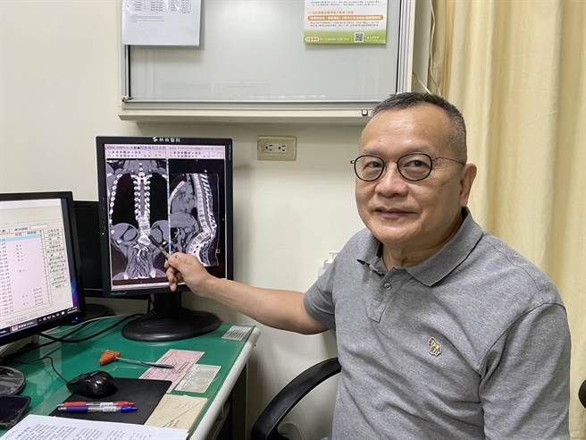 林新医院神经外科主任邵国寧指出，陈小弟经微创手术矫正，胸椎12节鸵角已大符减少（右边影像）。（林新医院供／冯惠宜台中传真）