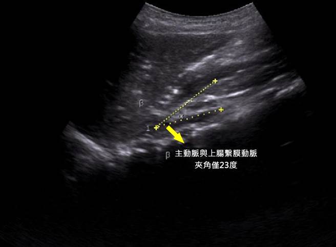 澄清医院中港院区儿科医师廖子涵表示，经超音波和电脑断层检查，发现该男孩的主动脉与上肠繫膜动脉之间夹角只有23度，正常应38到65度之间。（澄清医院提供／冯惠宜台中传真）
