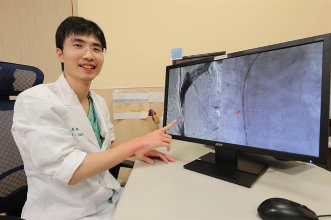 亚洲大学附属医院心臟外科主治医师黄俊晟提醒，部分洗肾病友曾因装置人工血管或洗肾廔管，引起单侧上半身及手臂水肿和表浅静脉扩张，往往是上腔静脉症候群的前兆。（亚大医院提供／潘虹恩台中传真）