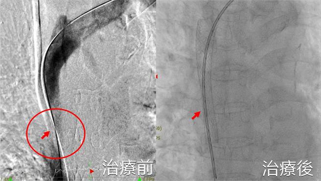 台中68岁张姓阿嬷长期洗肾，近日左手臂与脸部水肿严重，发现是上腔大静脉阻塞，幸利用气球扩张术及安放支架打通血管顺利「消肿」。（亚大医院提供／潘虹恩台中传真）