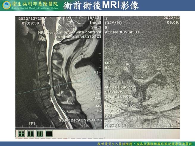 宋先生去年底发现颈椎狭窄，医师表示，若当时一个不小心，很容易导致全身瘫痪。（部立基隆医院提供／张志康基隆传真）