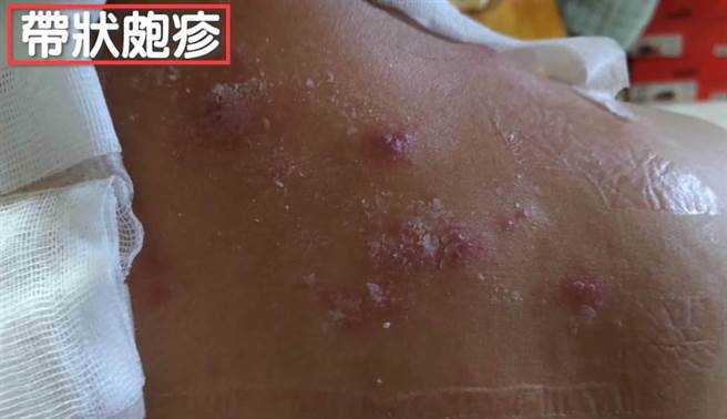 ▲俗称「皮蛇」的带状疱疹与水痘是同一种病毒，容易随着年龄增长或免疫低下时再度復发，其引发的神经痛可能持续数周甚至数年。（本报资料照）