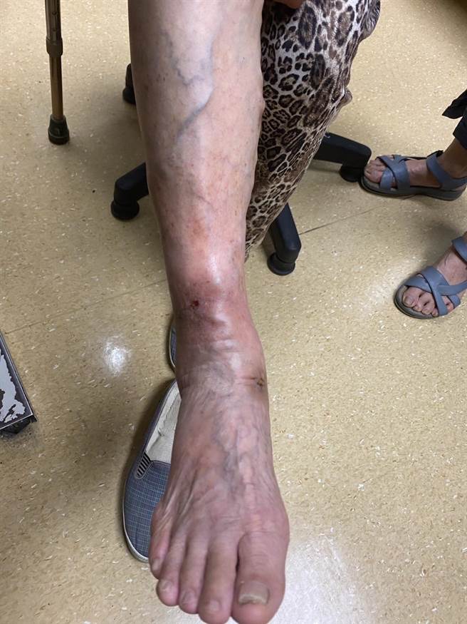 务农阿伯右脚静脉曲张严重，手术前血管明显肿胀浮出。（光田综合医院提供／陈淑娥台中传真）