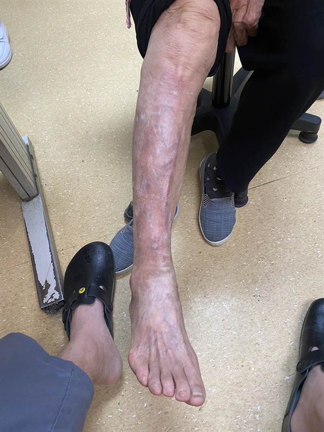 务农阿伯右脚静脉曲张严重，以无刀微创治疗后，恢復平整滑顺。（光田综合医院提供／陈淑娥台中传真）