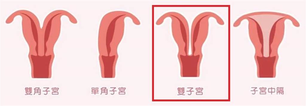 子宮畸形樣態中