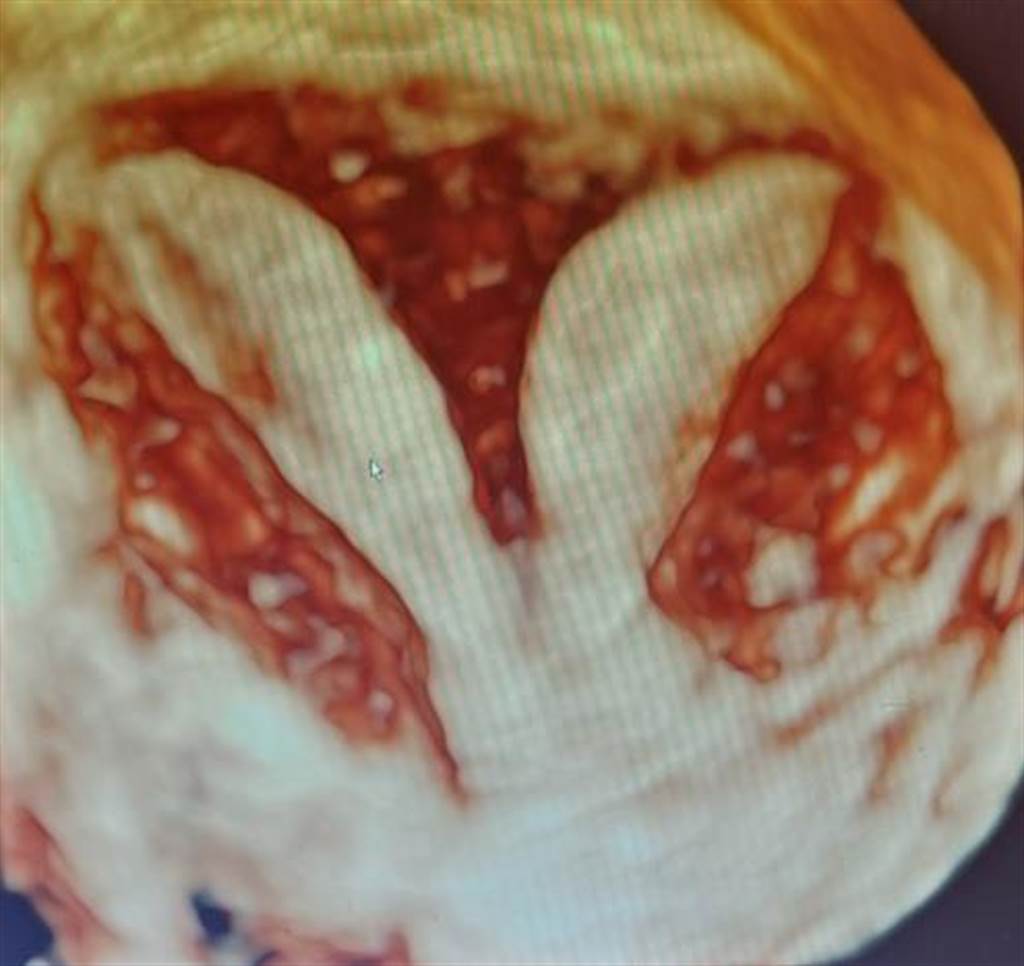 同時有雙子宮及雙陰道只是其中一種