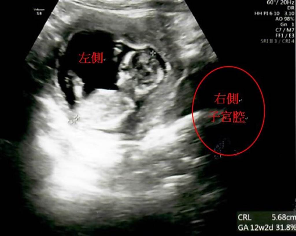 常見的型態還有雙角子宮、單角子宮、子宮中隔…等。(茂盛醫院提供／馮惠宜台中傳真)