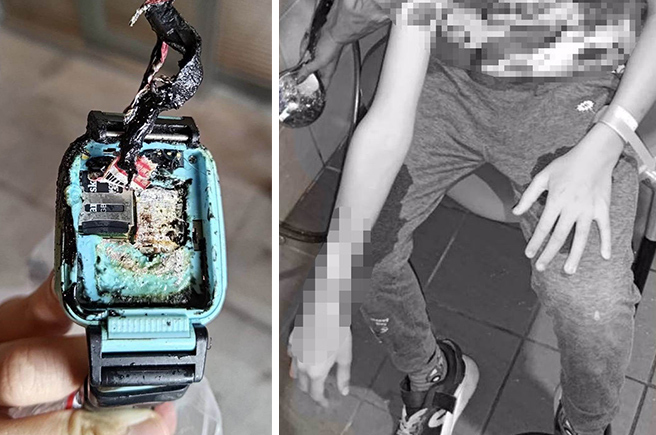 男童配戴的智慧型手表突然爆炸自燃，右手臂2度燒燙傷。（合成圖／新北市消防局第五大隊提供）
