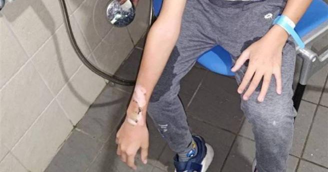 男童手上戴的智慧型手錶，突然爆炸導致手臂灼傷。（圖／三立新聞提供）