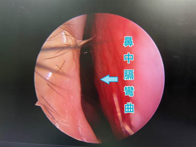 乌日林新医院耳鼻喉科医师吴佩璇指出，鼻中膈是位于2个鼻腔之间的分隔板，当分隔板左右弯曲时会压缩到两侧鼻腔空间，造成鼻腔通道不顺畅而导致鼻塞。（乌日林新医院提供／潘虹恩台中传真）