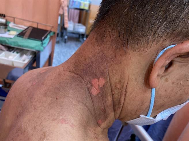 罗男使用未稀释的精油按摩，造成全身百分之十灼伤。（院方提供／孙英哲彰化传真）