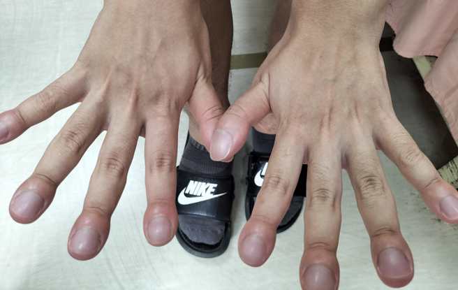 男姓患者罹患罕见疾病「厚皮骨膜增生」，导致20根手脚趾特别地肿胀。（图／取自苏一峰脸书）