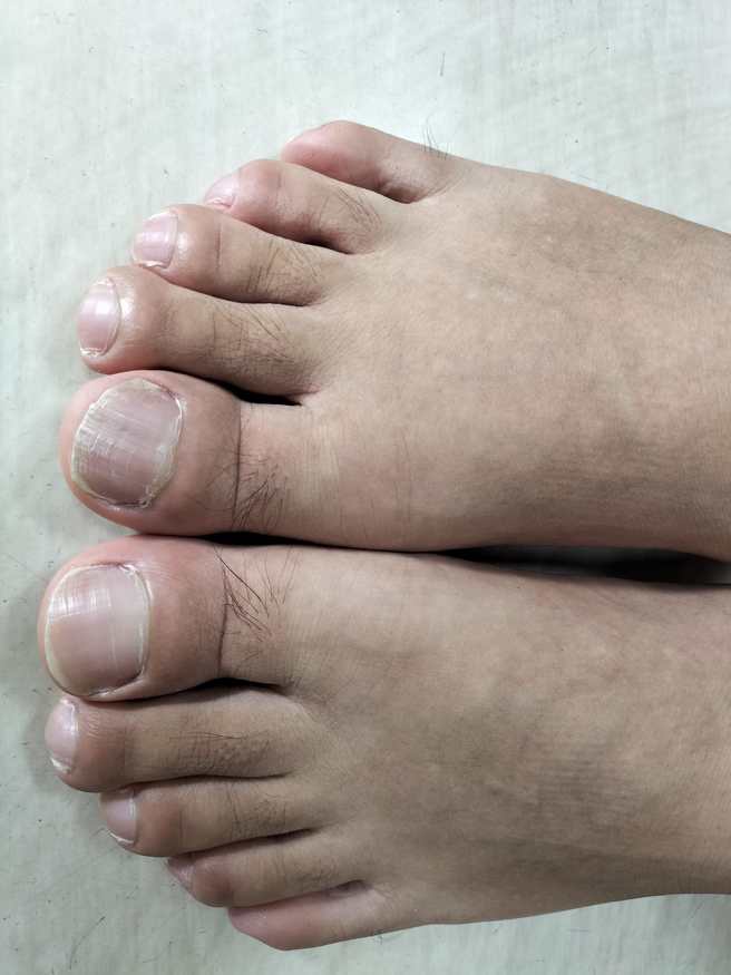 苏一峰说，若成年后手指、脚趾才突然发生肿胀，要提防有心肺问题，甚至可能罹患癌症。（图／取自苏一峰脸书）