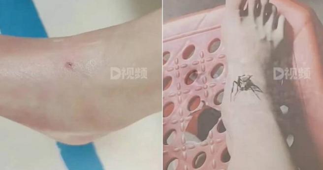 中国一名女童被蛇咬伤，奶奶以为是蜈蚣，竟放蜘蛛在伤口上。（图／翻摄自微博）