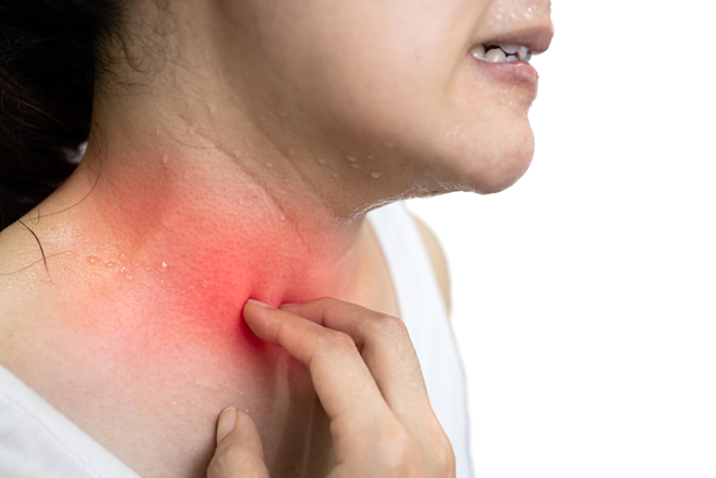 营养师李婉萍列出5种可能导致湿疹反覆发作的食物，分别是牛奶、高油脂与甜食、麸质、甲壳类海鲜及食物添加物。（示意图／Shutterstock）