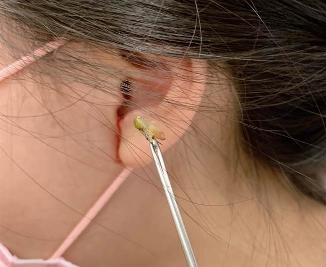 医师在小五女童耳中抓出误入耳道、长约1公分的小蟋蟀。(联新国际医院提供／吕筱蝉桃园传真)